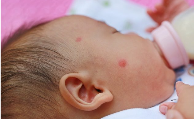 Perbedaan Alergi Susu Sapi dan Intoleransi Laktosa pada Bayi